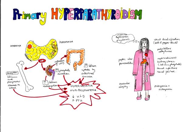 primary parathyroidism