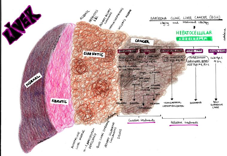 hepatocellular carcinoma