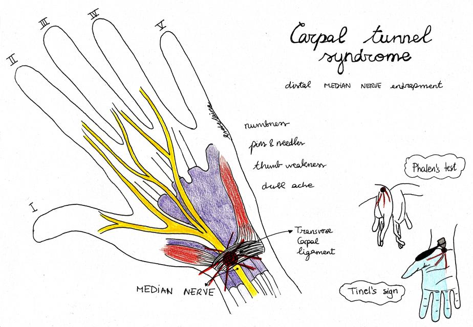 carpal-tunnel-syndrome